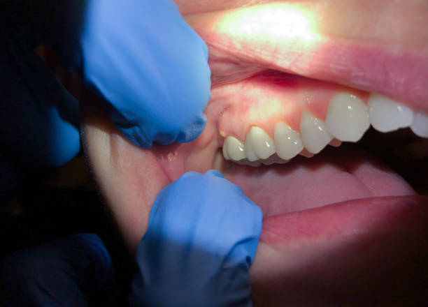 Best Emergency Dental Care for Abscessed Tooth in St John, IN